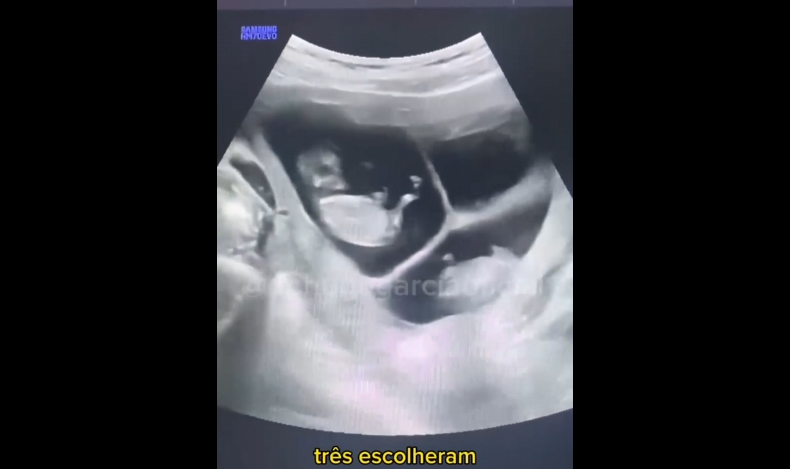 Vídeo de ultrassonografia viraliza após médico revelar surpresa inesperada!