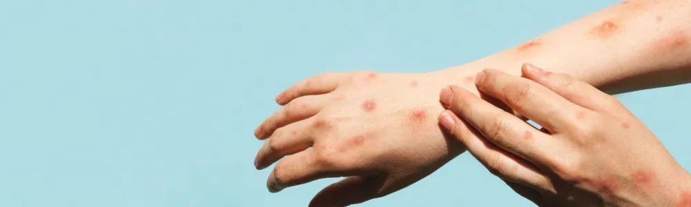 OMS declara retorno da Mpox como emergência de Saúde Mundial
